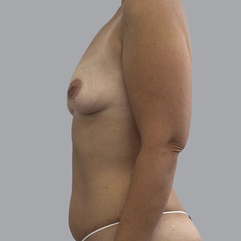 Breast Augmentation with Fat Transfer Before & After Gallery - Patient 398594 - Image 5