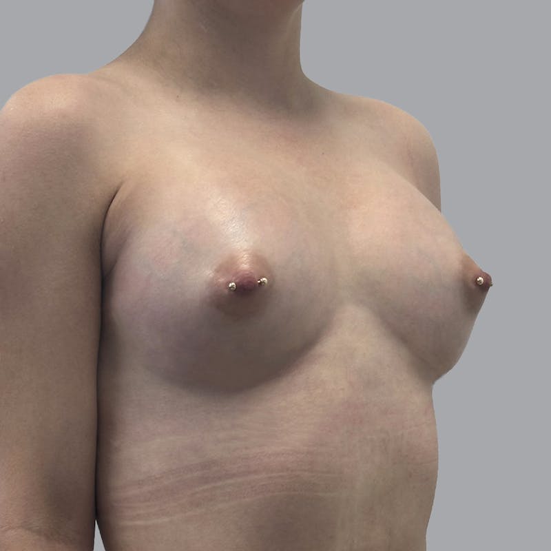 Breast Augmentation with Fat Transfer Before & After Gallery - Patient 212668 - Image 4