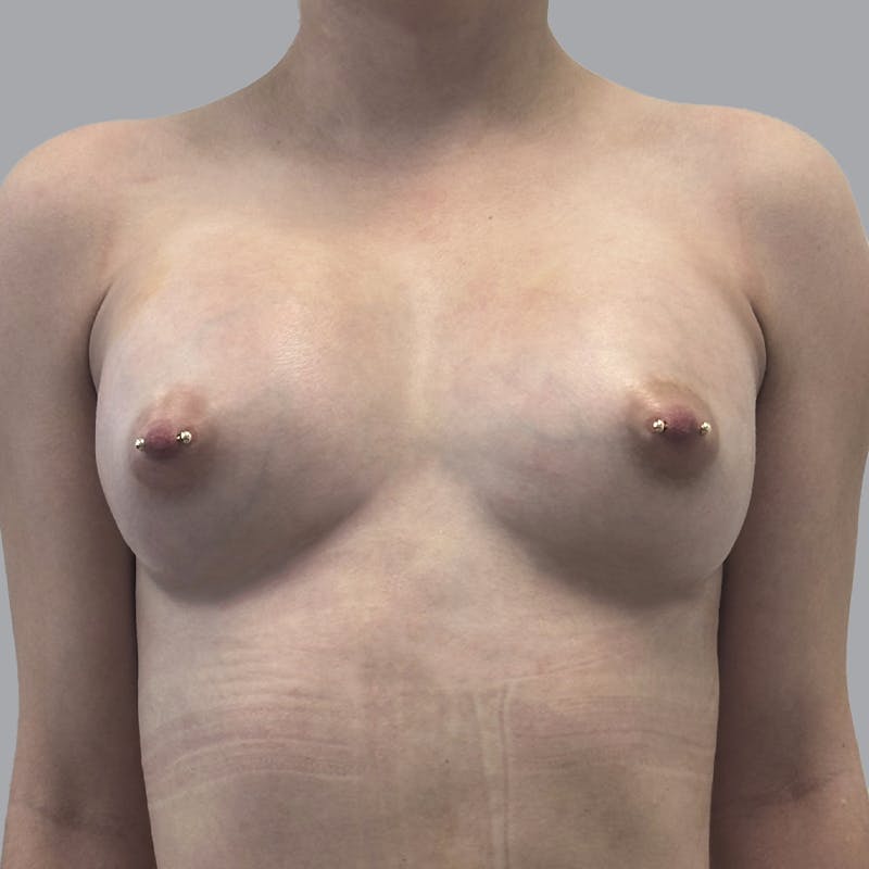 Breast Augmentation with Fat Transfer Before & After Gallery - Patient 212668 - Image 2