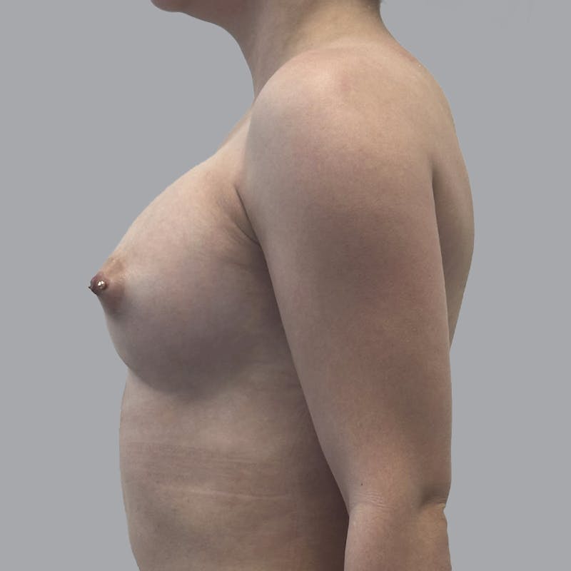 Breast Augmentation with Fat Transfer Before & After Gallery - Patient 212668 - Image 6