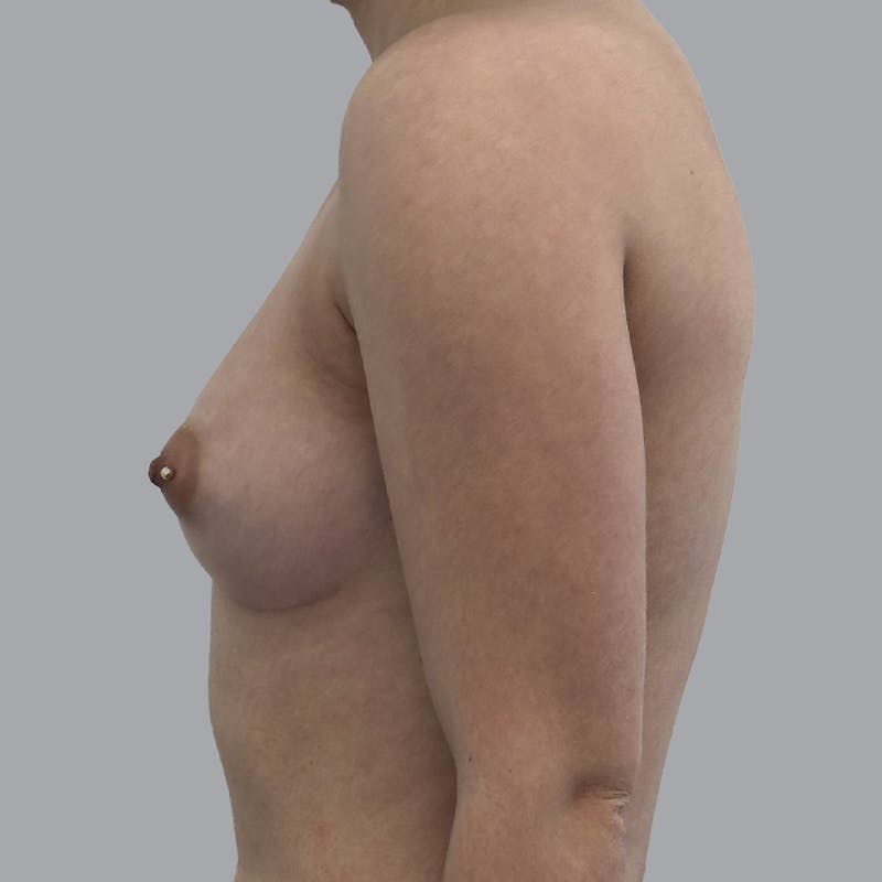 Breast Augmentation with Fat Transfer Before & After Gallery - Patient 212668 - Image 5