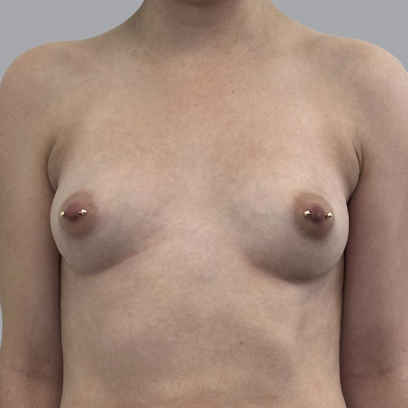 Breast Augmentation with Fat Transfer Before & After Gallery - Patient 212668 - Image 1