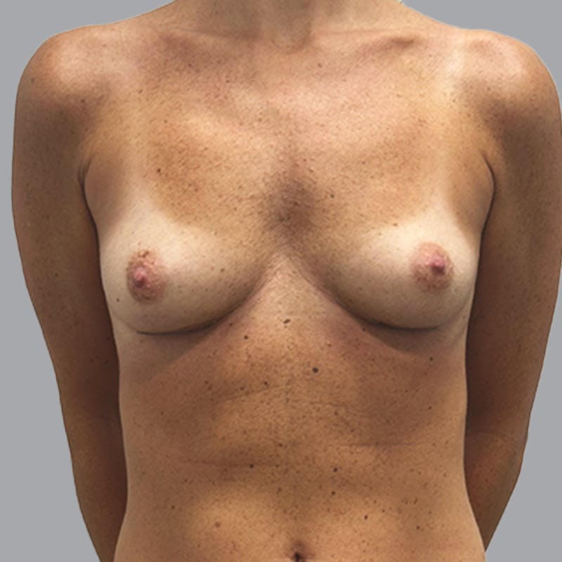 Breast Implant Removal Before & After Gallery - Patient 216399 - Image 2