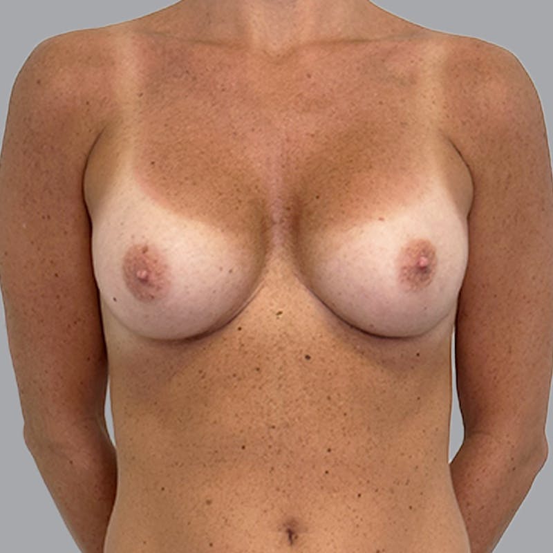 Breast Implant Removal Before & After Gallery - Patient 216399 - Image 1