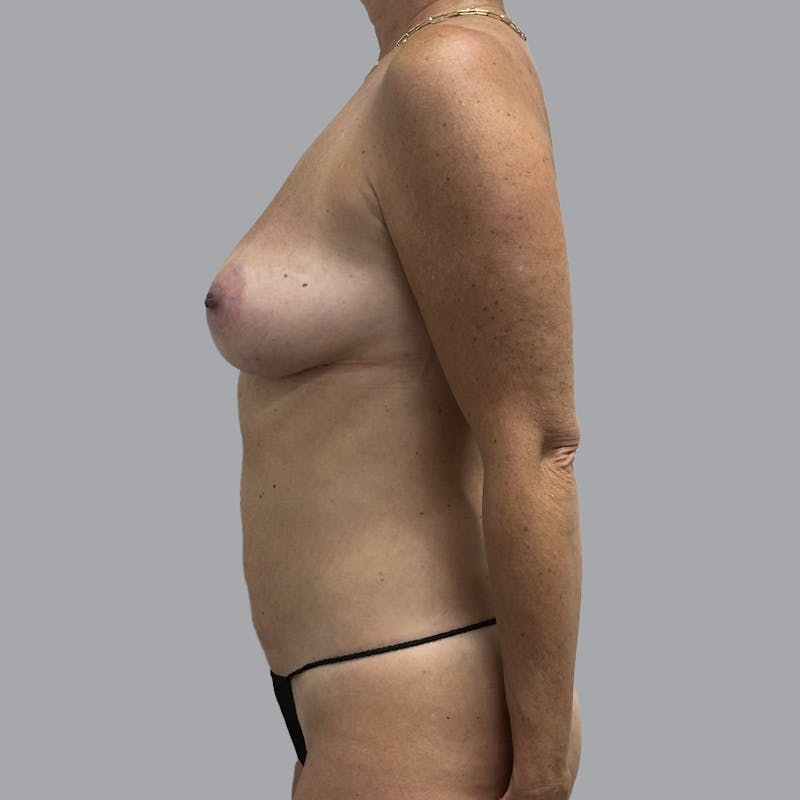 Breast Augmentation with Fat Transfer Before & After Gallery - Patient 441182 - Image 6