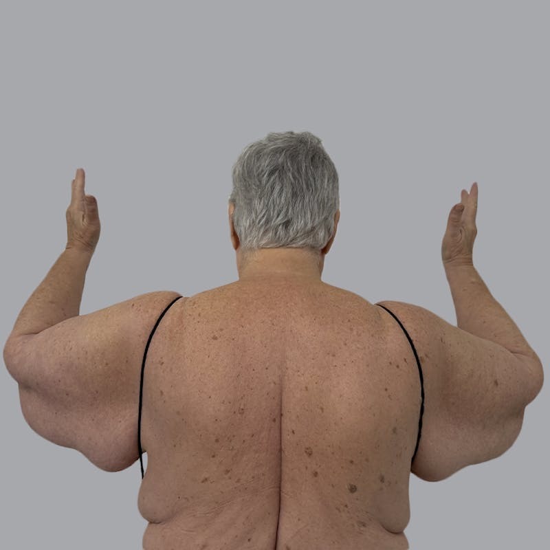 Arm Liposuction Before & After Gallery - Patient 269844 - Image 1