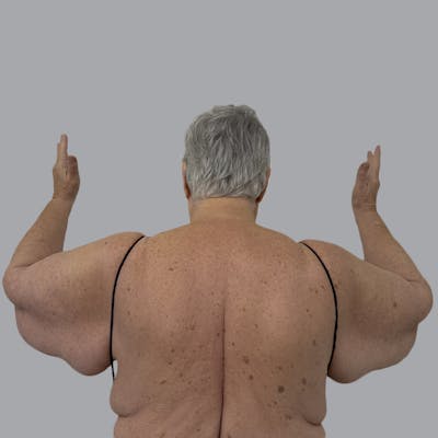 Lipedema Before & After Gallery - Patient 421876 - Image 1