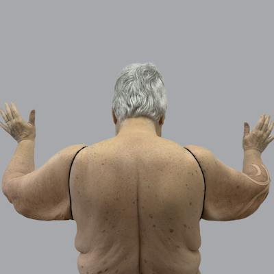 Lipedema Before & After Gallery - Patient 421876 - Image 2