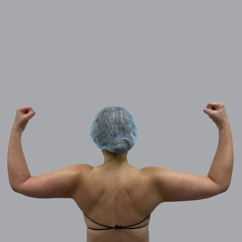 Arm Liposuction Before & After Gallery - Patient 113268 - Image 2