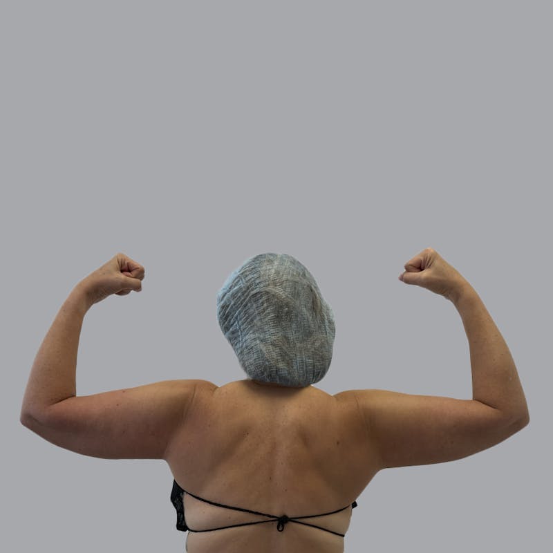 Arm Liposuction Before & After Gallery - Patient 113268 - Image 1