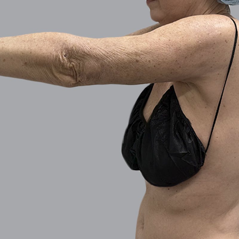 Arm Liposuction Before & After Gallery - Patient 139638 - Image 6