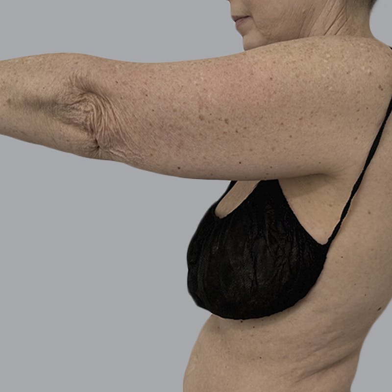 Arm Liposuction Before & After Gallery - Patient 139638 - Image 5