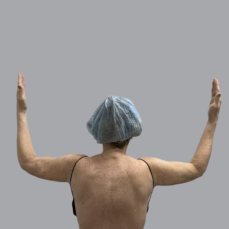 Arm Liposuction Before & After Gallery - Patient 139638 - Image 2