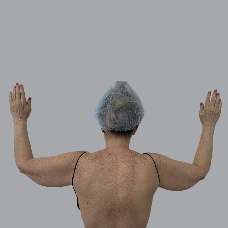 Arm Liposuction Before & After Gallery - Patient 139638 - Image 1