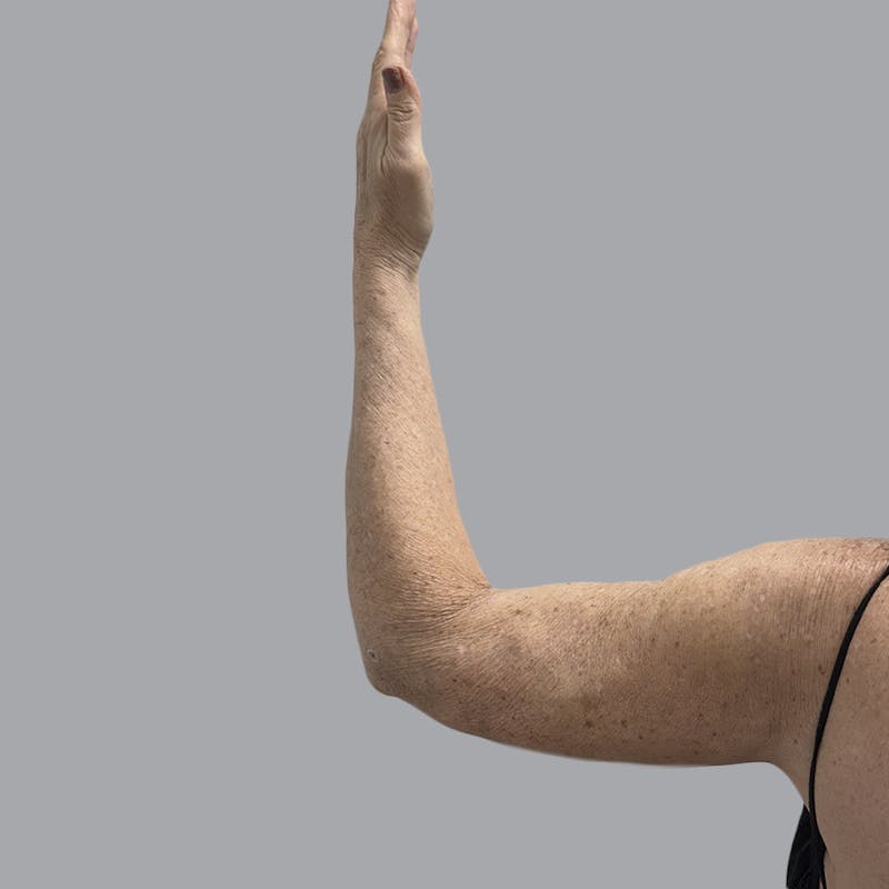 Arm Liposuction Before & After Gallery - Patient 139638 - Image 4