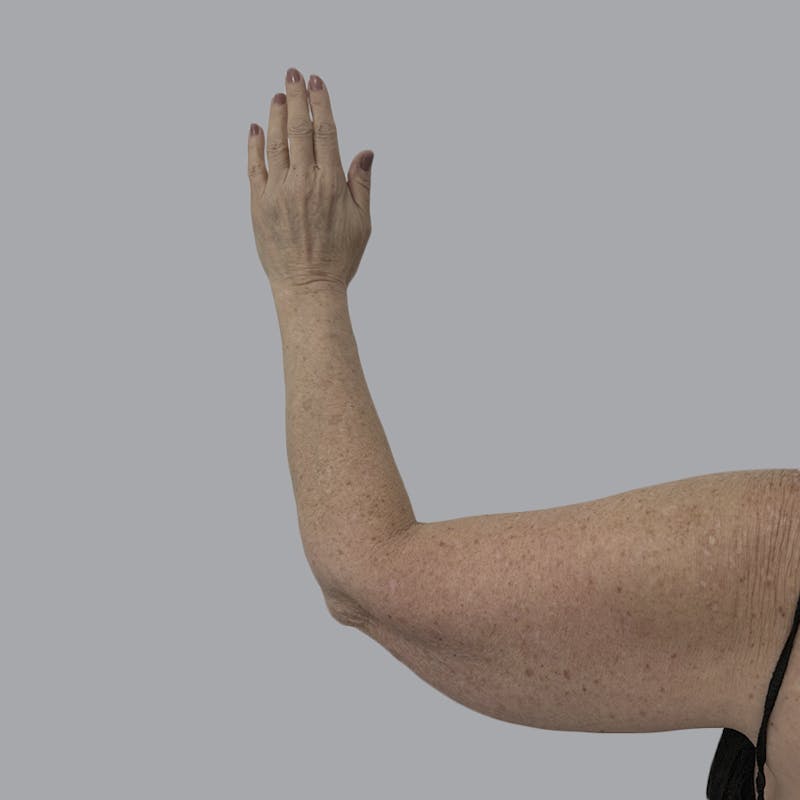 Arm Liposuction Before & After Gallery - Patient 139638 - Image 3