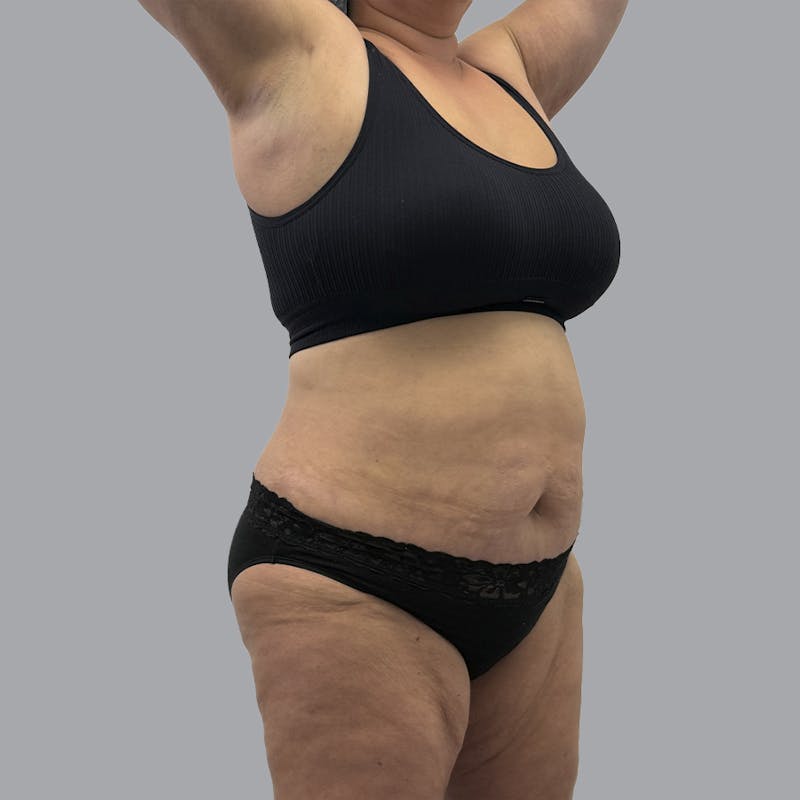Abdominoplasty Before & After Gallery - Patient 346793 - Image 4