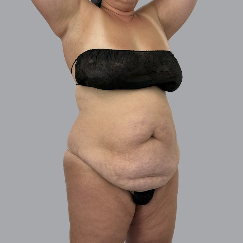 Abdominoplasty Before & After Gallery - Patient 346793 - Image 3