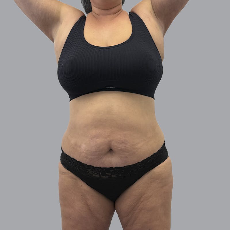Abdominoplasty Before & After Gallery - Patient 346793 - Image 2