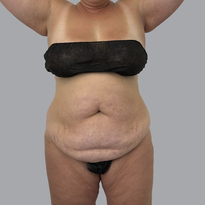 Abdominoplasty Before & After Gallery - Patient 346793 - Image 1