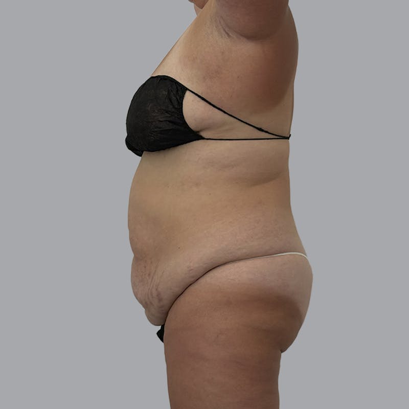 Abdominoplasty Before & After Gallery - Patient 346793 - Image 5