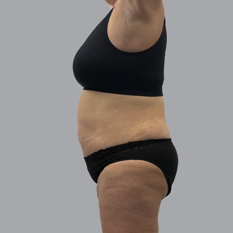 Abdominoplasty Before & After Gallery - Patient 346793 - Image 6