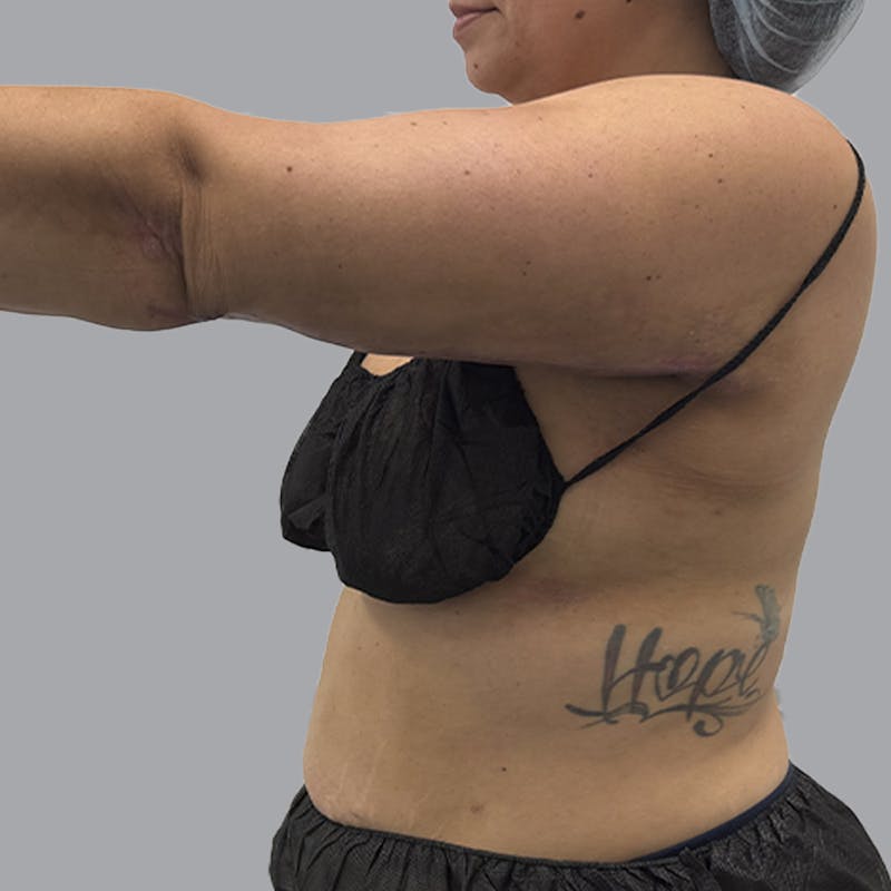 Arm Lift Before & After Gallery - Patient 419827 - Image 8