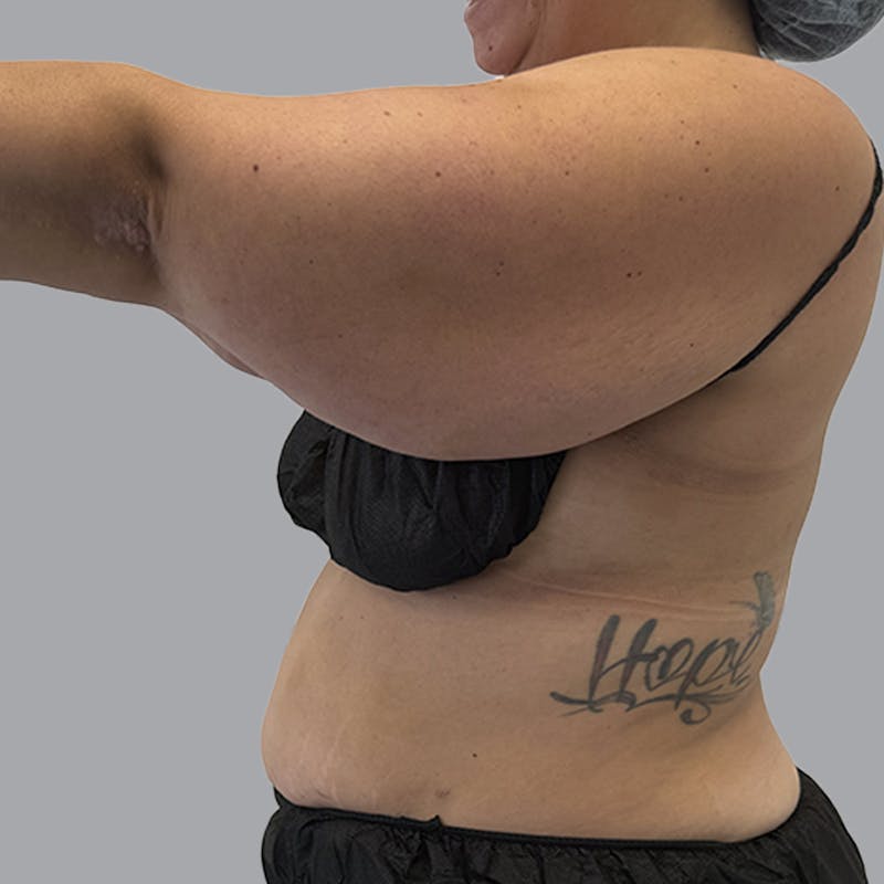 Arm Lift Before & After Gallery - Patient 419827 - Image 7