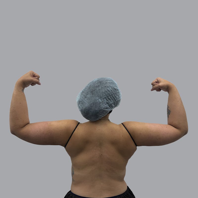 Arm Lift Before & After Gallery - Patient 419827 - Image 2