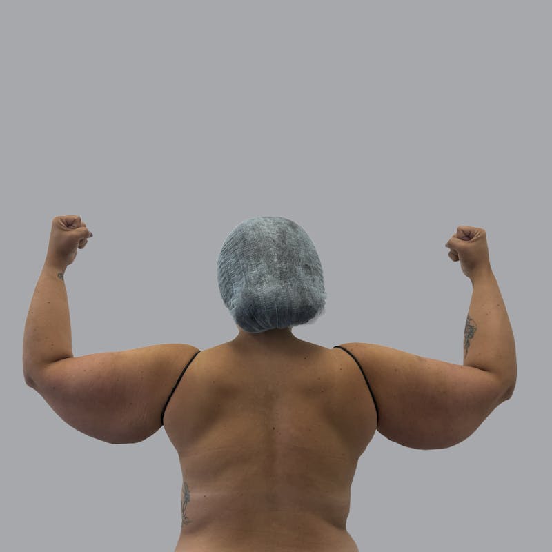 Arm Lift Before & After Gallery - Patient 419827 - Image 1