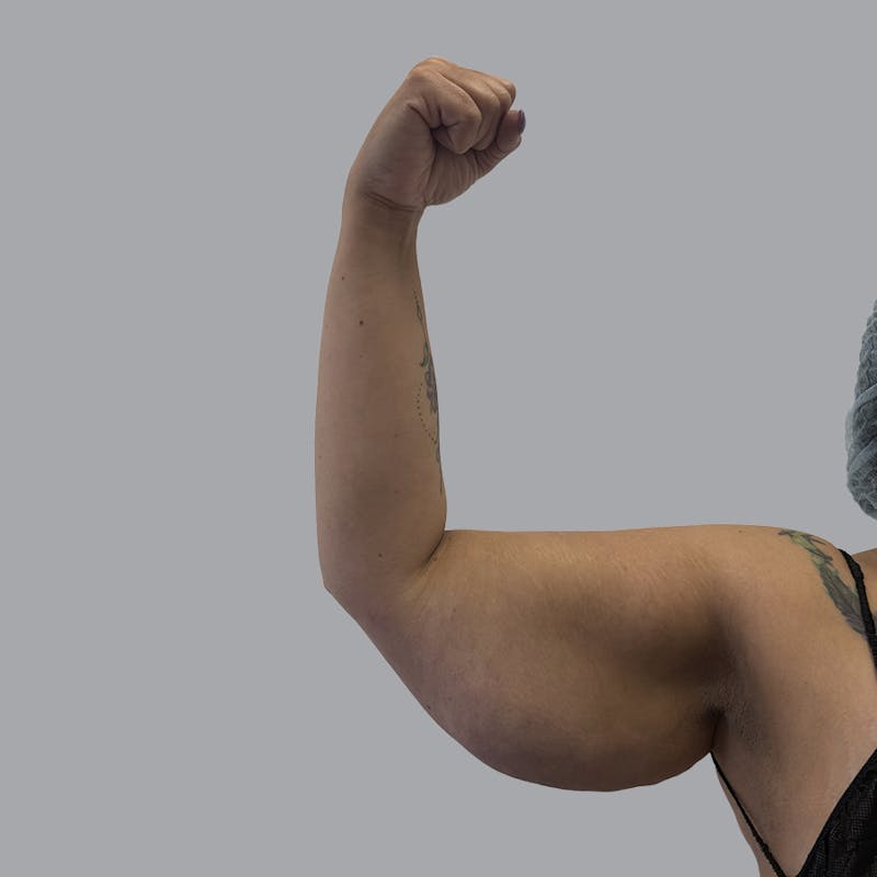 Arm Lift Before & After Gallery - Patient 419827 - Image 5