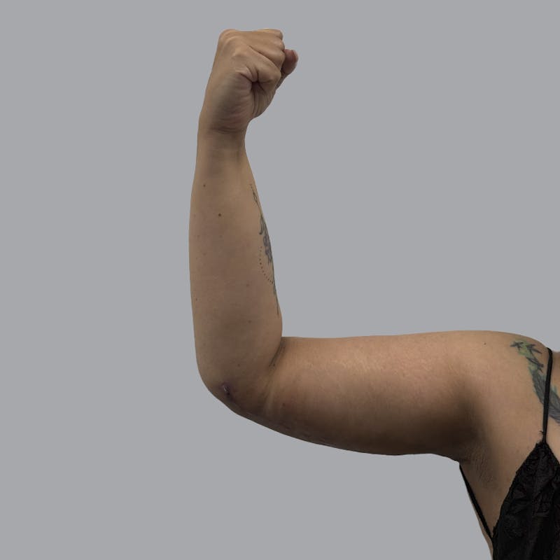 Arm Lift Before & After Gallery - Patient 419827 - Image 6