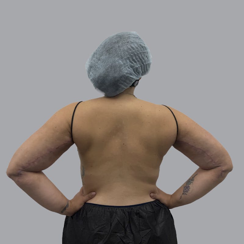 Arm Lift Before & After Gallery - Patient 419827 - Image 4