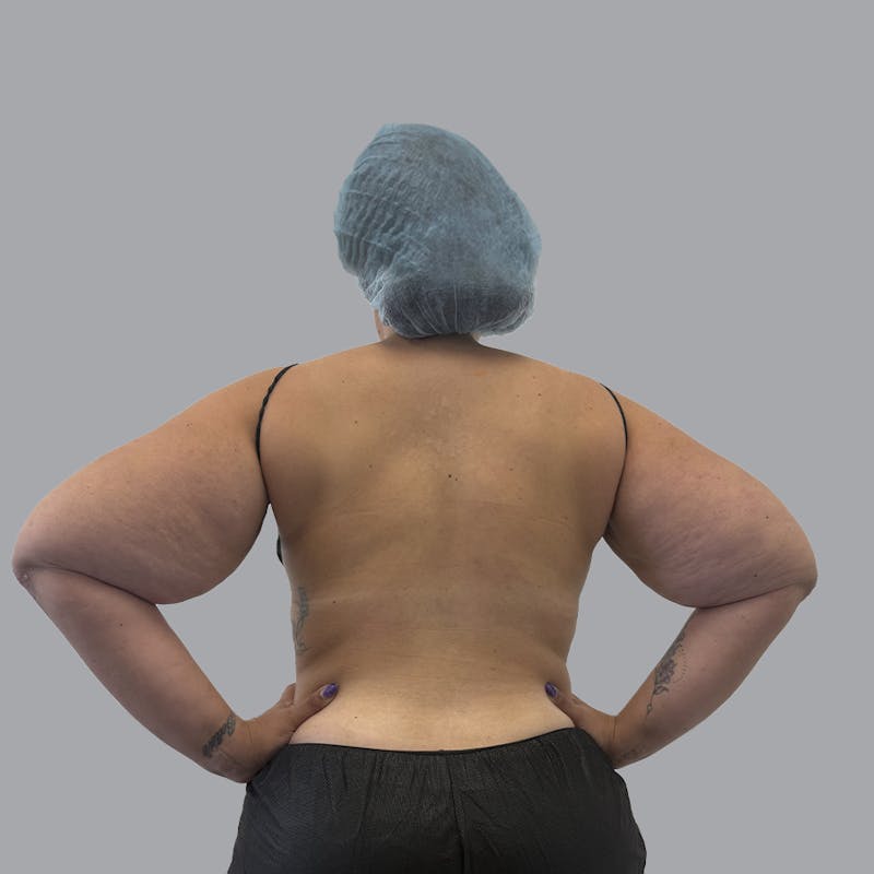 Arm Lift Before & After Gallery - Patient 419827 - Image 3