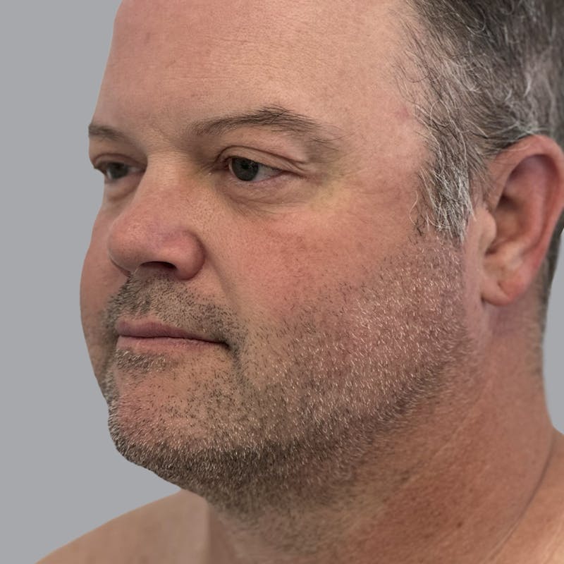 Eyelid Surgery Before & After Gallery - Patient 491388 - Image 3