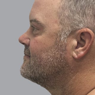 Eyelid Surgery Before & After Gallery - Patient 491388 - Image 6