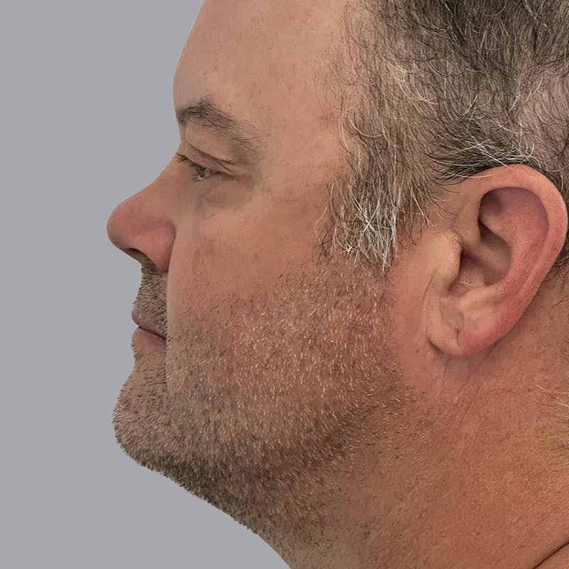 Eyelid Surgery Before & After Gallery - Patient 491388 - Image 5
