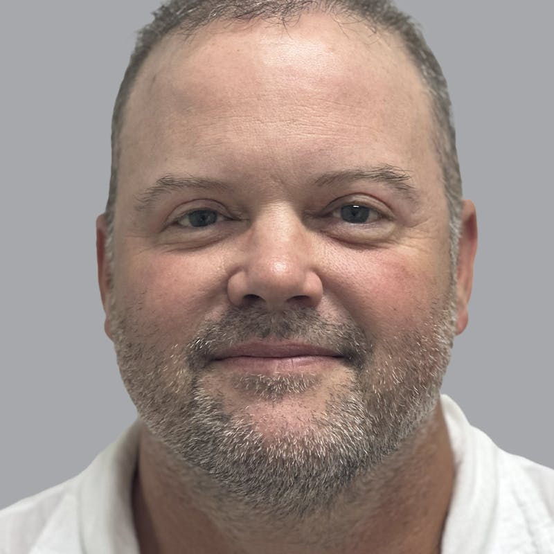 Eyelid Surgery Before & After Gallery - Patient 491388 - Image 2