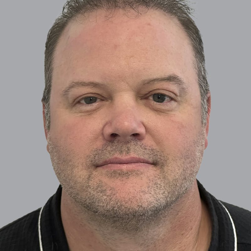 Eyelid Surgery Before & After Gallery - Patient 491388 - Image 1
