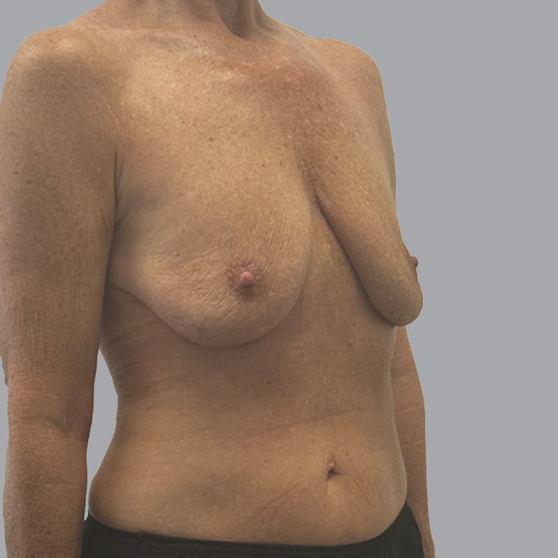 Breast Implant Removal Before & After Gallery - Patient 140884 - Image 4