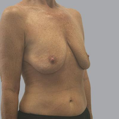 Breast Implant Removal Before & After Gallery - Patient 140884 - Image 4