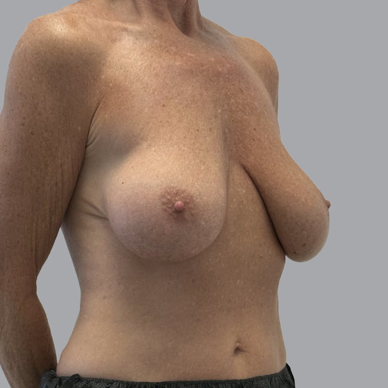 Breast Implant Removal Before & After Gallery - Patient 140884 - Image 3