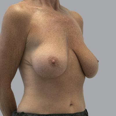 Breast Implant Removal Before & After Gallery - Patient 140884 - Image 3