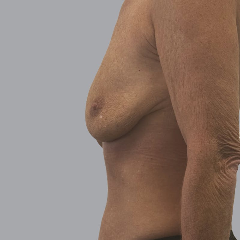 Breast Implant Removal Before & After Gallery - Patient 140884 - Image 6