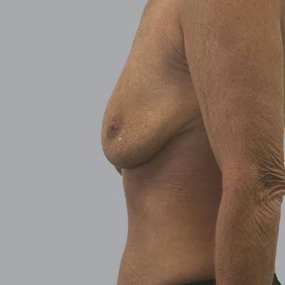 Breast Implant Removal Before & After Gallery - Patient 140884 - Image 6