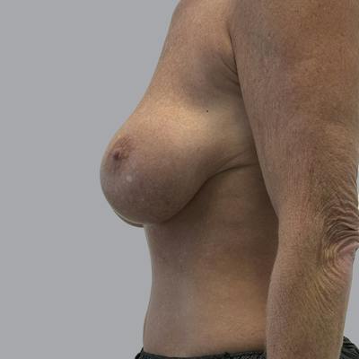 Breast Implant Removal Before & After Gallery - Patient 140884 - Image 5