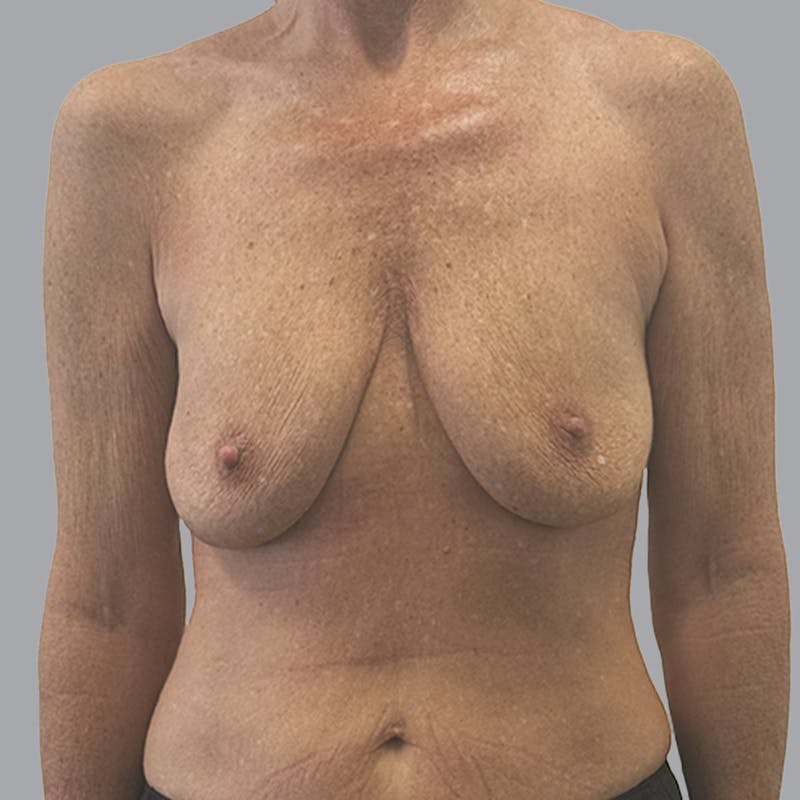 Breast Implant Removal Before & After Gallery - Patient 140884 - Image 2