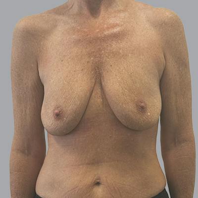 Breast Implant Removal Before & After Gallery - Patient 140884 - Image 2