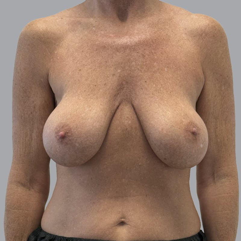 Breast Implant Removal Before & After Gallery - Patient 140884 - Image 1