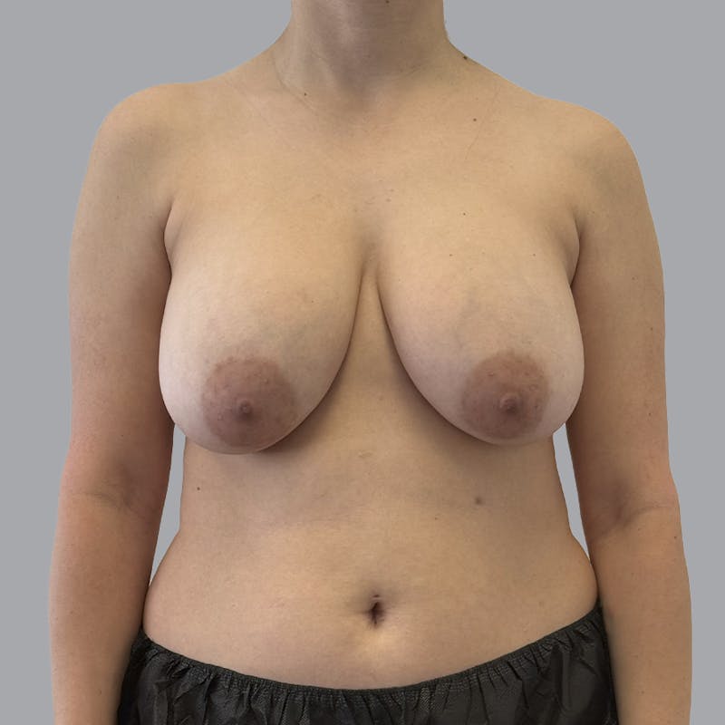Breast Implant Removal Before & After Gallery - Patient 240068 - Image 1
